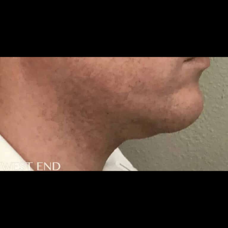 Before Image: Kybella - right-side