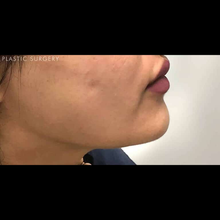 After Image: Chin Augmentation with Dermal Filler - right-side