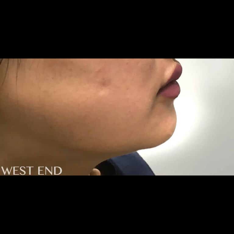 Before Image: Chin Augmentation with Dermal Filler - right-side