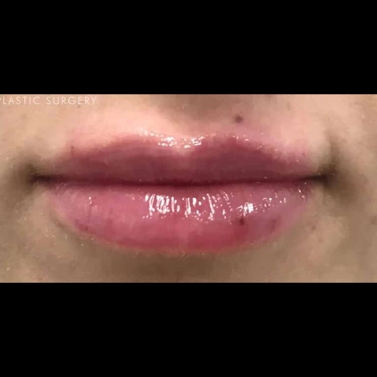 After Image: Lip Filler - front
