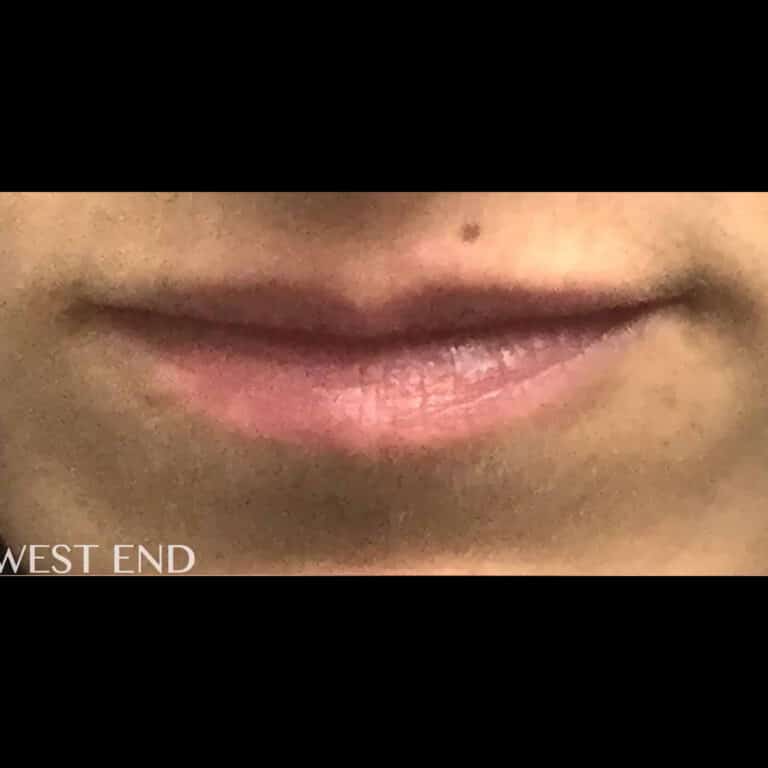 Before Image: Lip Filler - front