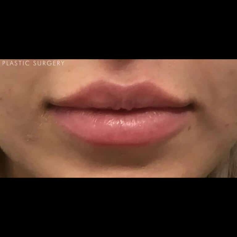 After Image: Lip Filler - front