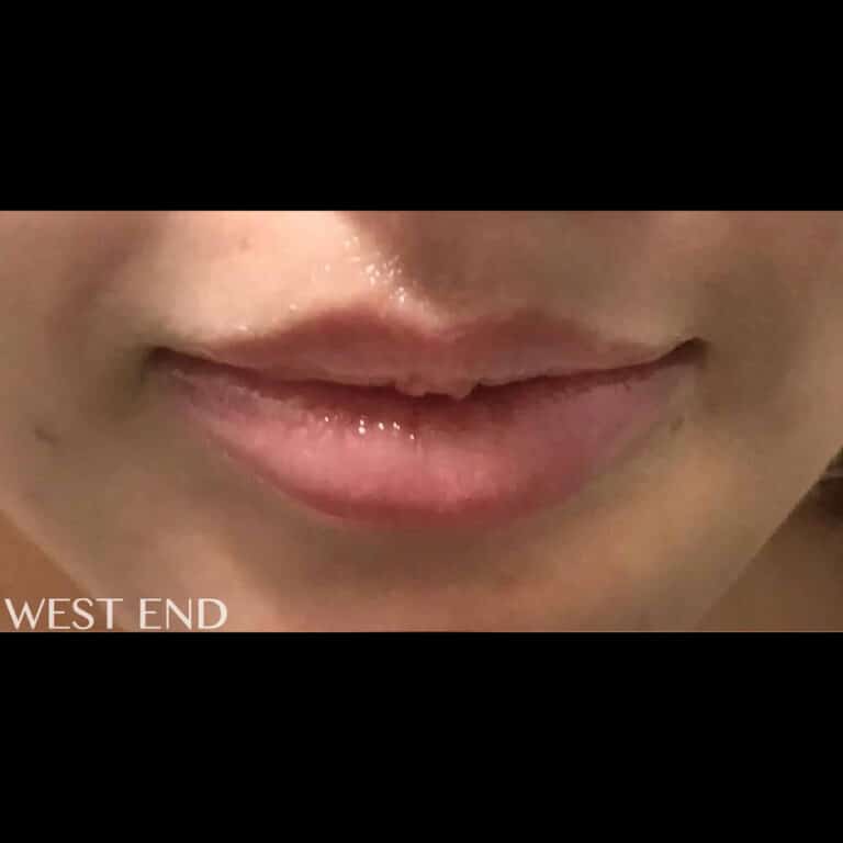 Before Image: Lip Filler - front