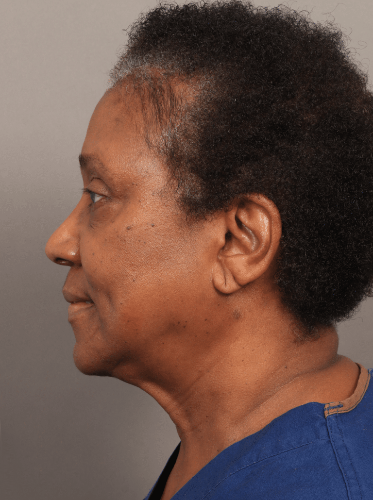 Before Image: Lower Face & Neck Lift, Upper Eyelid Lift, Brow Lift, and Fat Grafting (2 Weeks Post-op) - left-side