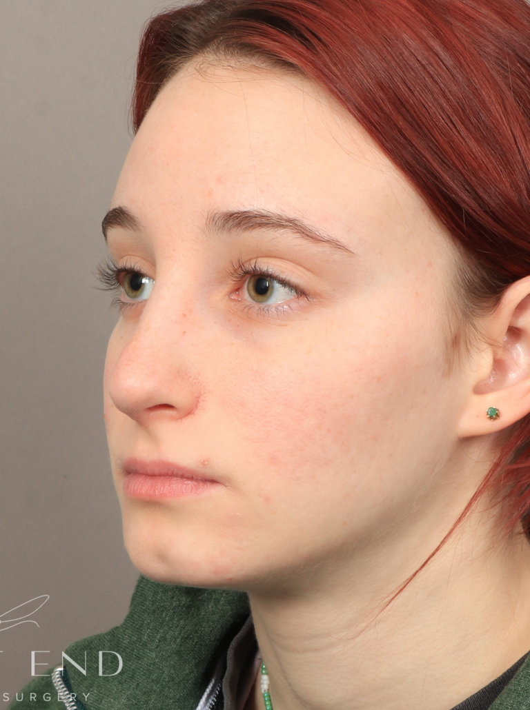 After Image: Open Rhinoplasty (8.5 Months Post-op) - left-front-oblique