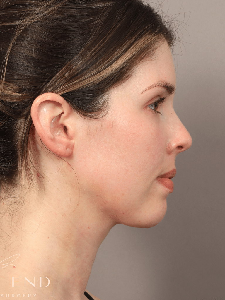 After Image: Liposuction & Renuvion Skin Tightening (10 Days Post-op) - right-side