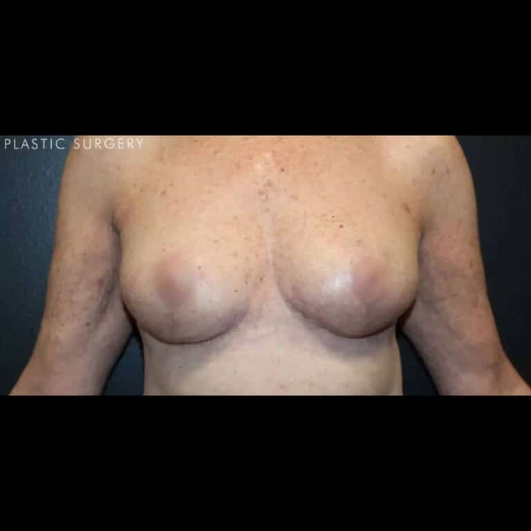 After Image: Breast Reduction - front