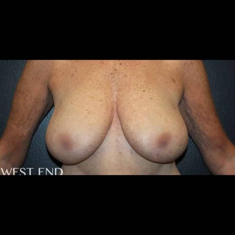 Before Image: Breast Reduction - front