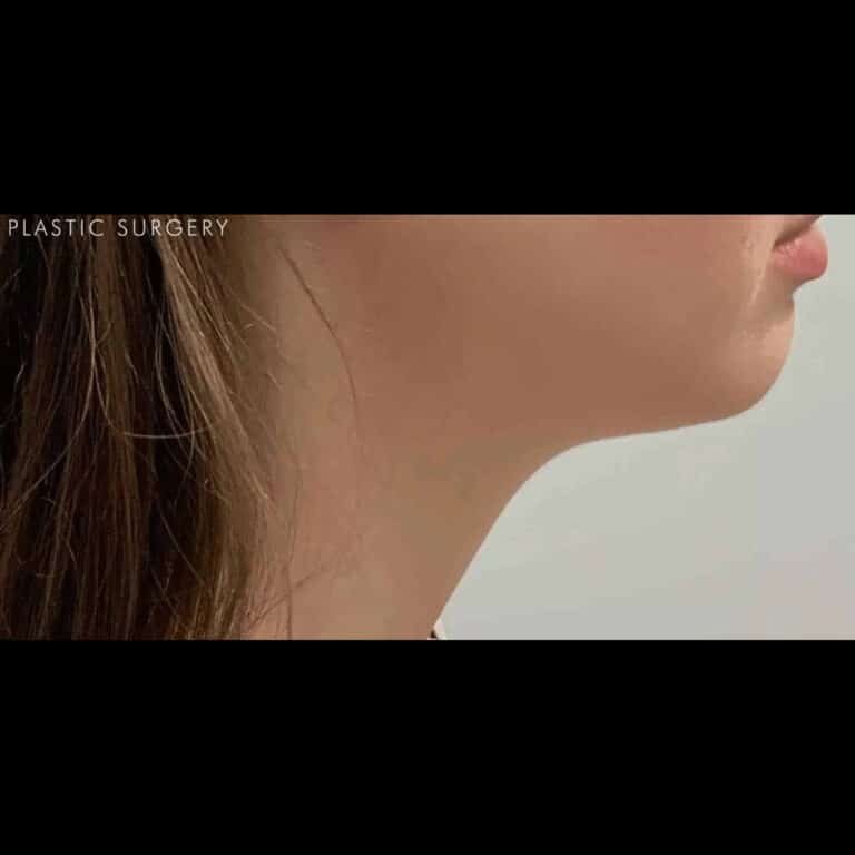 After Image: Kybella - right-side