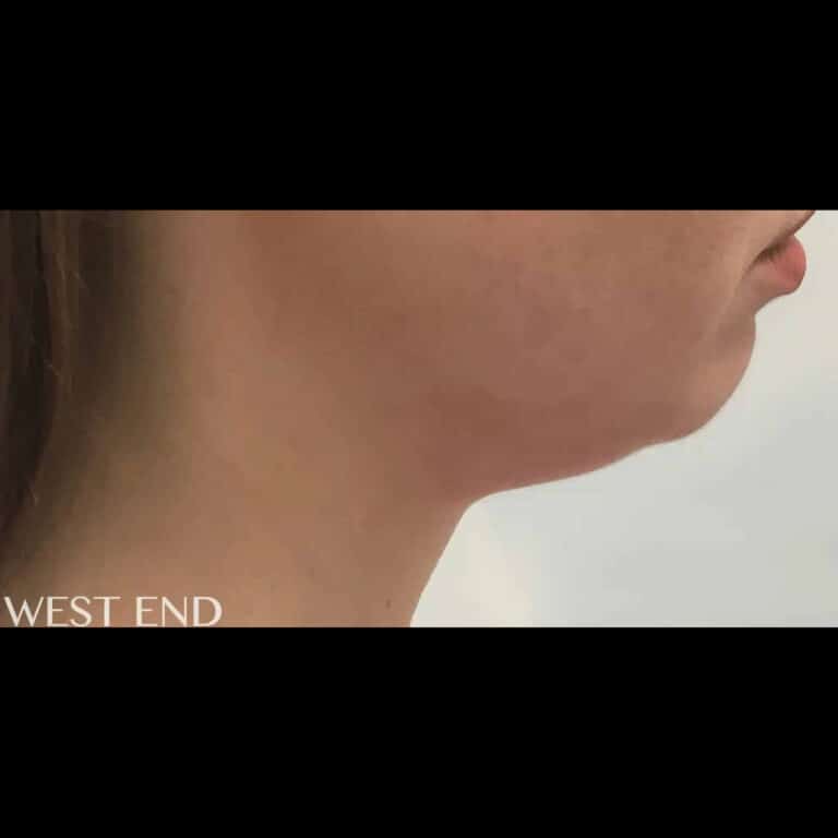 Before Image: Kybella - right-side