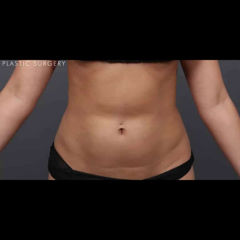 After Image: CoolSculpting - front