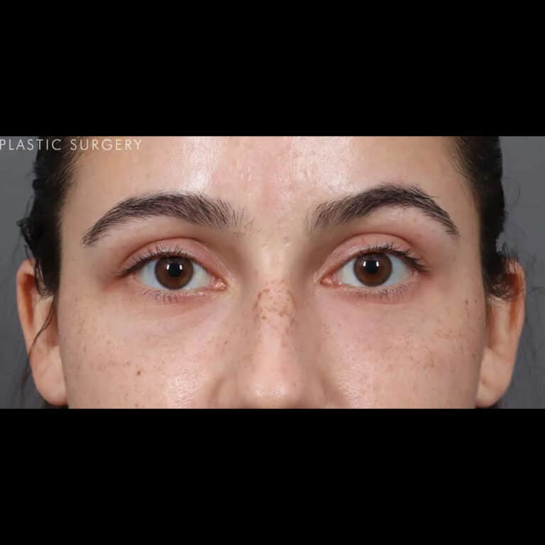 After Image: Under-Eye Filler - front