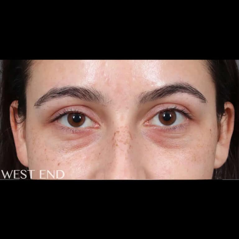 Before Image: Under-Eye Filler - front