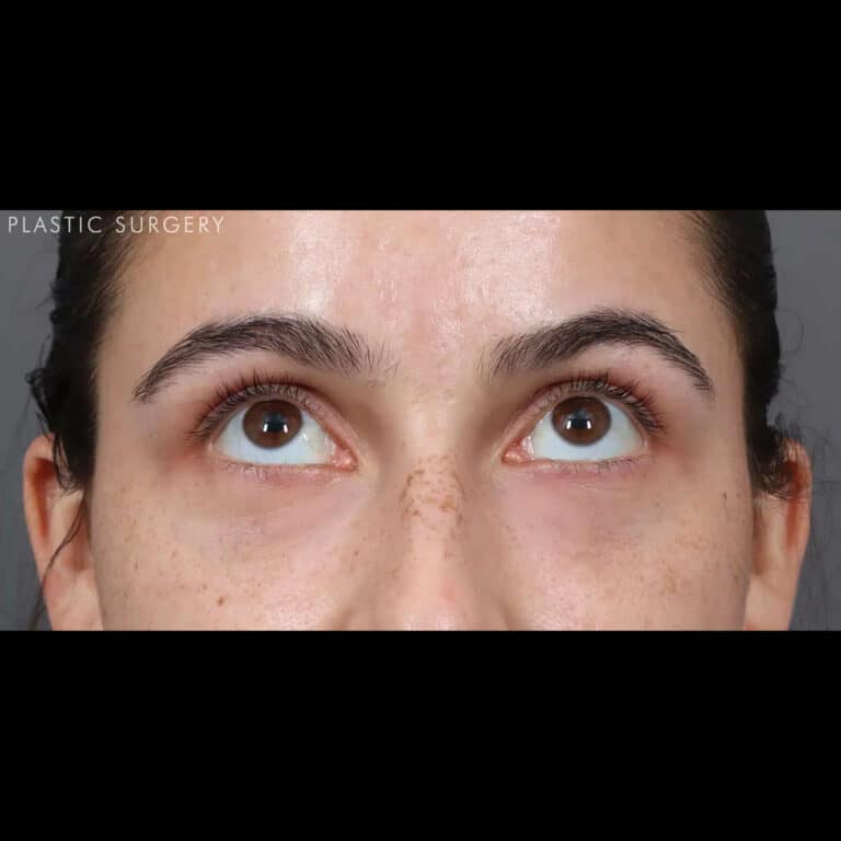 After Image: Under-Eye Filler - front