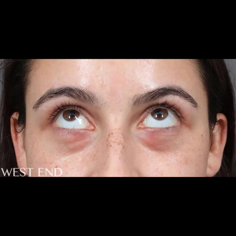Before Image: Under-Eye Filler - front