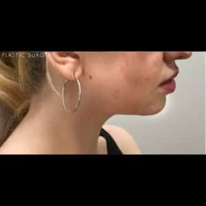 After Image: Kybella & Chin Augmentation with Dermal Filler