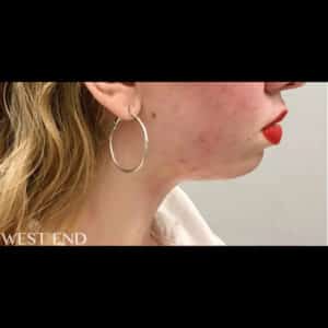 Before Image: Kybella & Chin Augmentation with Dermal Filler