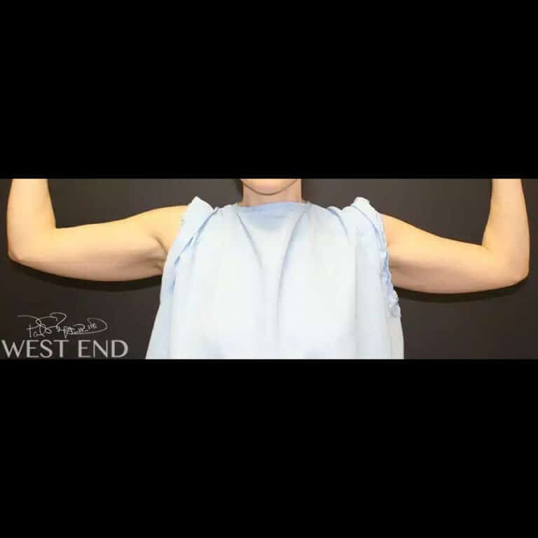 Before Image: Liposuction - front