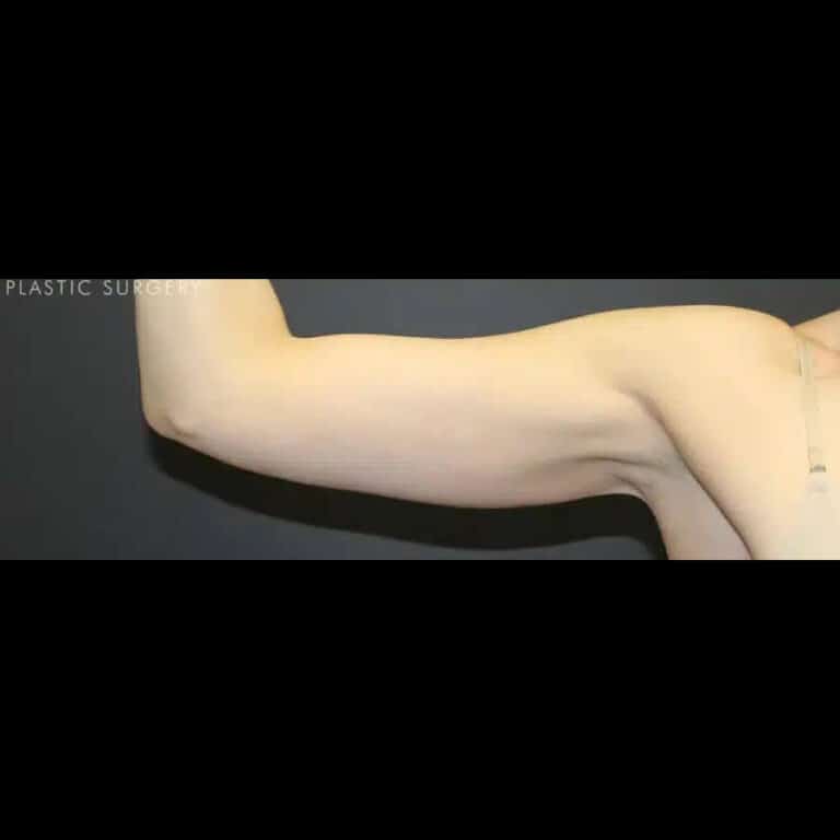 After Image: Liposuction - front