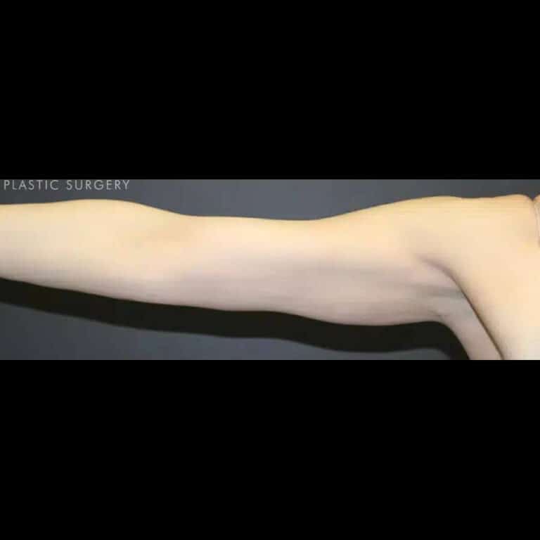 After Image: Liposuction - front