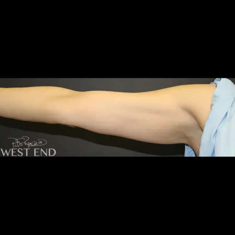 Before Image: Liposuction - front