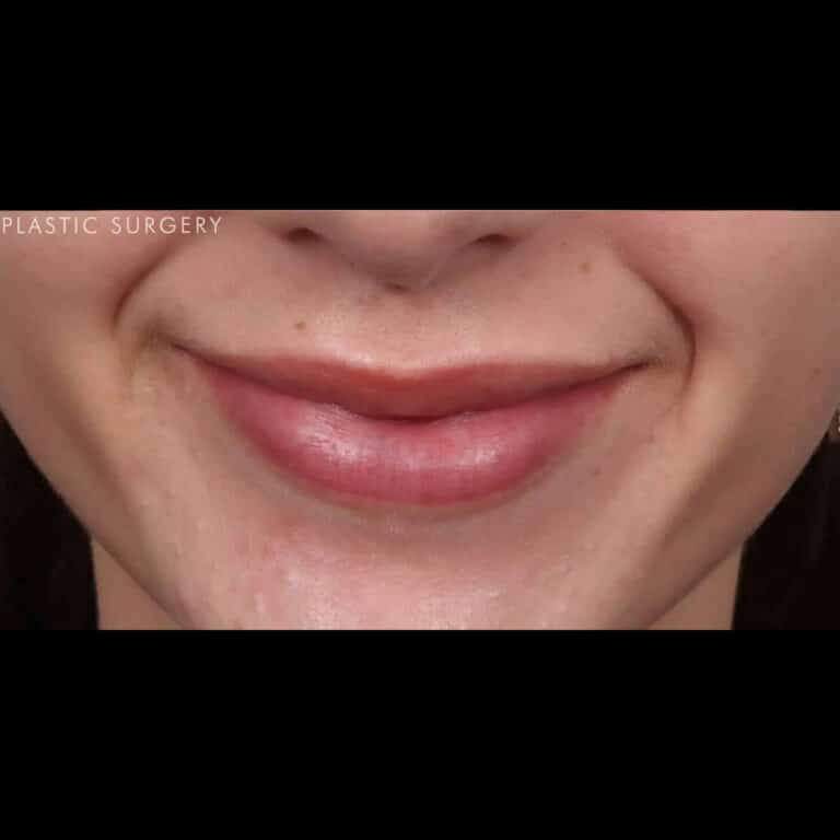 After Image: Lip Filler - front