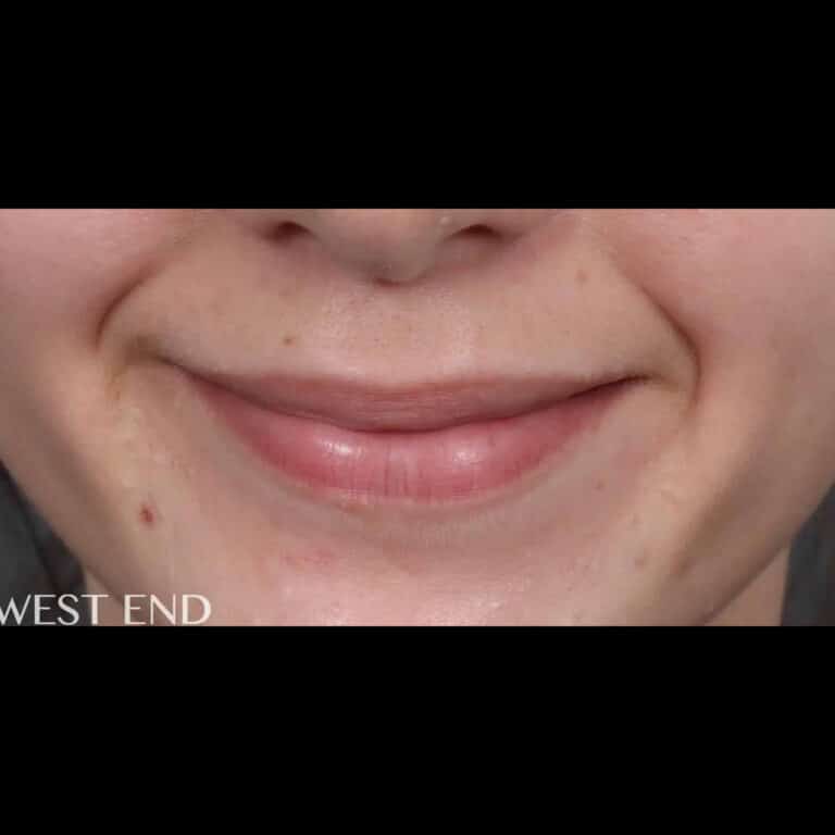 Before Image: Lip Filler - front