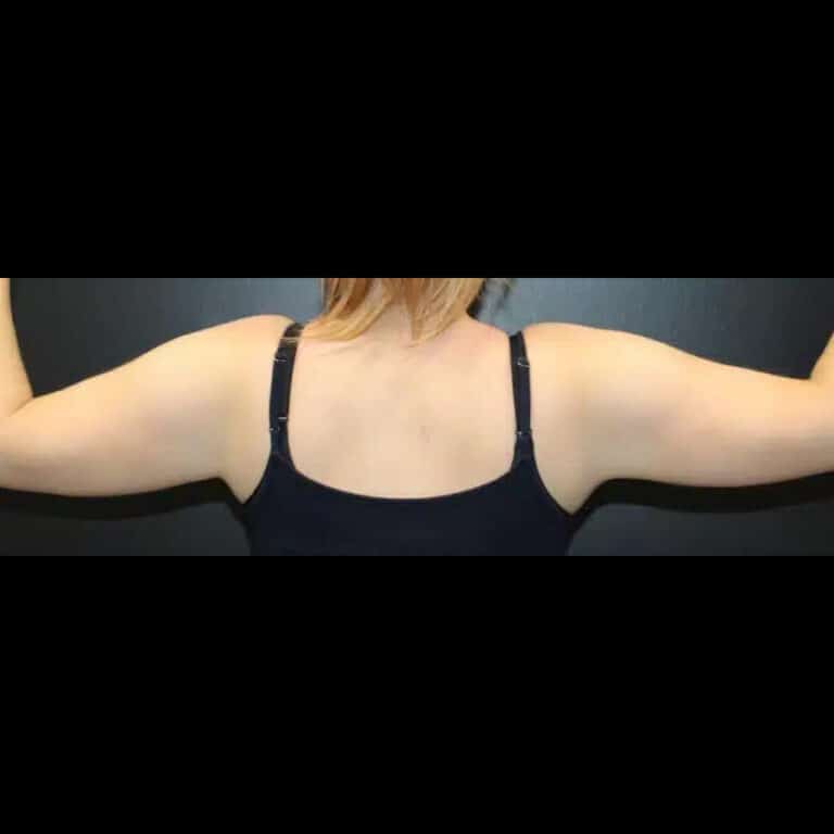 Before Image: Liposuction and Renuvion Skin Tightening - back