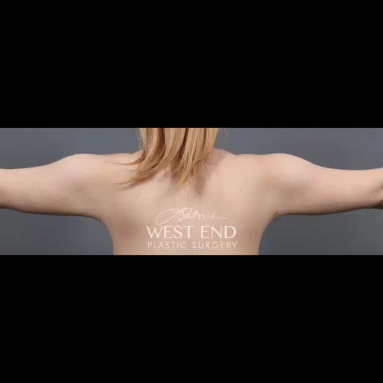 After Image: Liposuction and Renuvion Skin Tightening - back