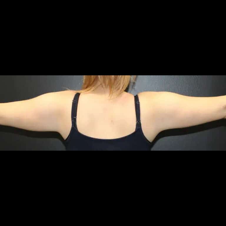Before Image: Liposuction and Renuvion Skin Tightening - back