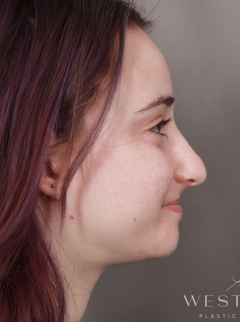 Before Image: Open Rhinoplasty (8.5 Months Post-op) - right-side