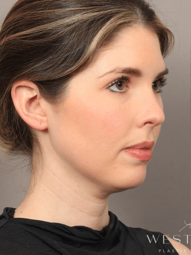 Before Image: Liposuction & Renuvion Skin Tightening (10 Days Post-op) - right-front-oblique