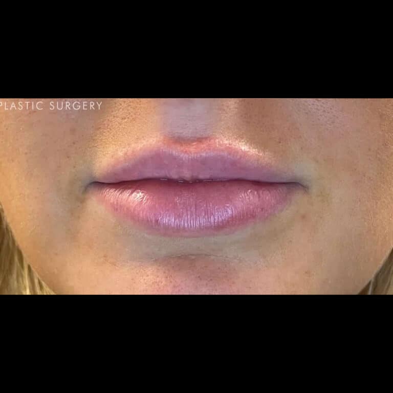 After Image: Lip Filler - front