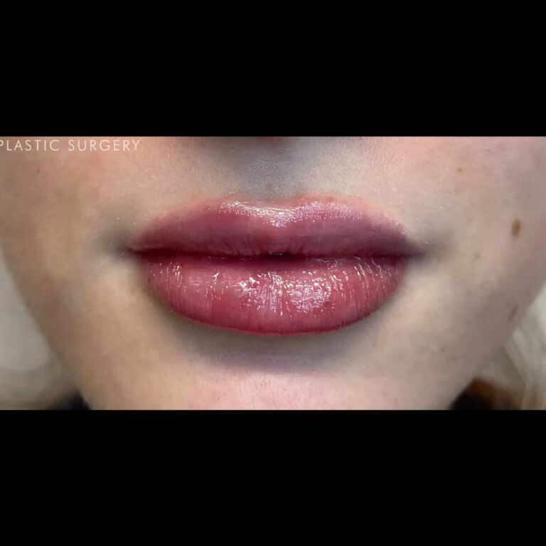 After Image: Lip Filler - front