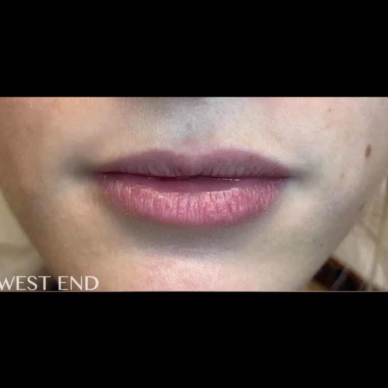 Before Image: Lip Filler - front