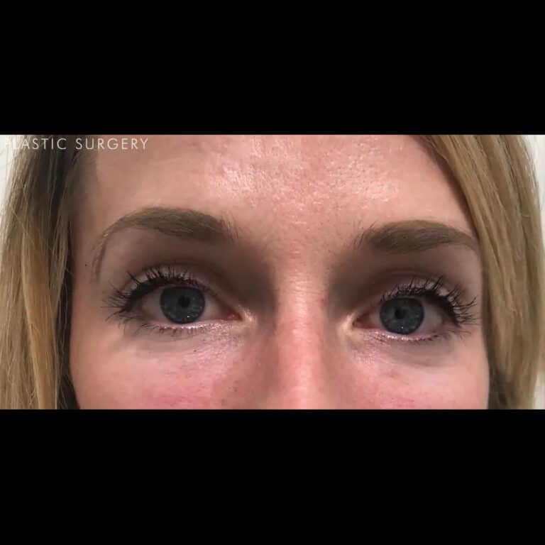 After Image: Under-Eye Filler - front