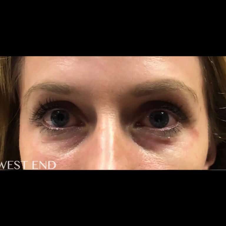 Before Image: Under-Eye Filler - front