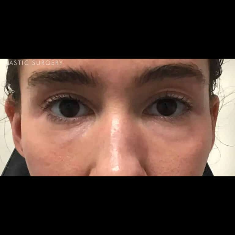 After Image: Under-Eye Filler - front