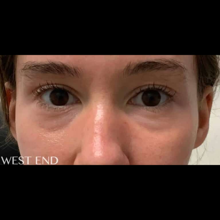 Before Image: Under-Eye Filler - front