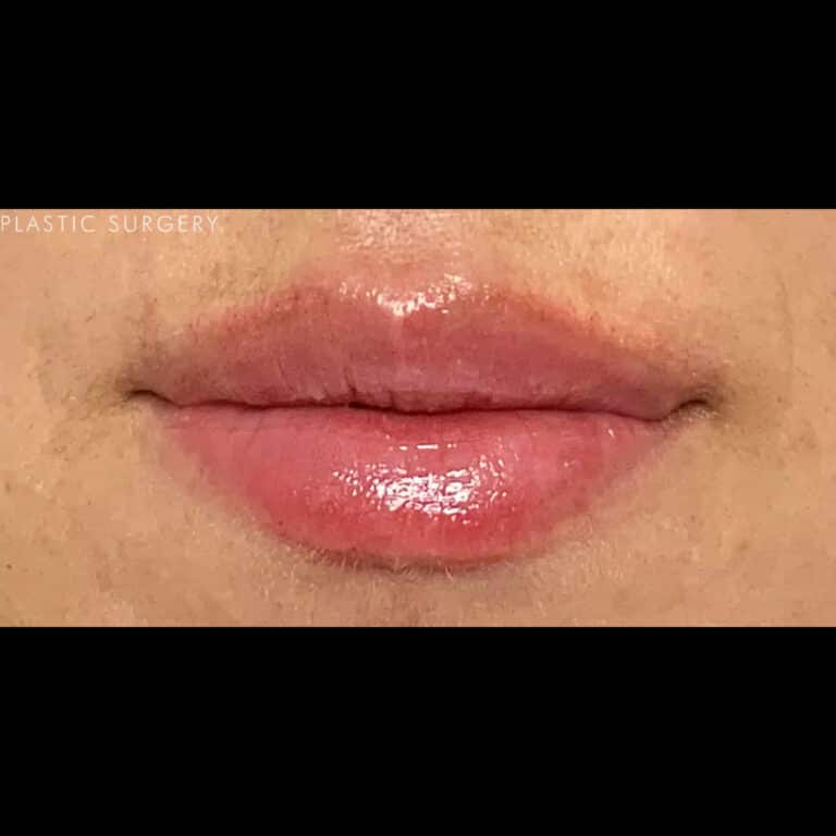 After Image: Lip Filler - front