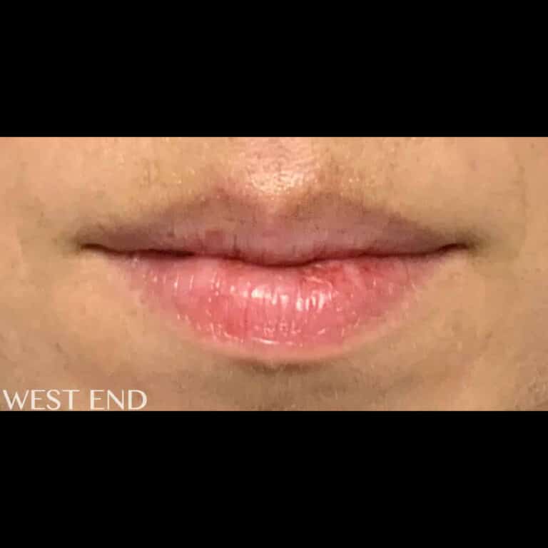 Before Image: Lip Filler - front