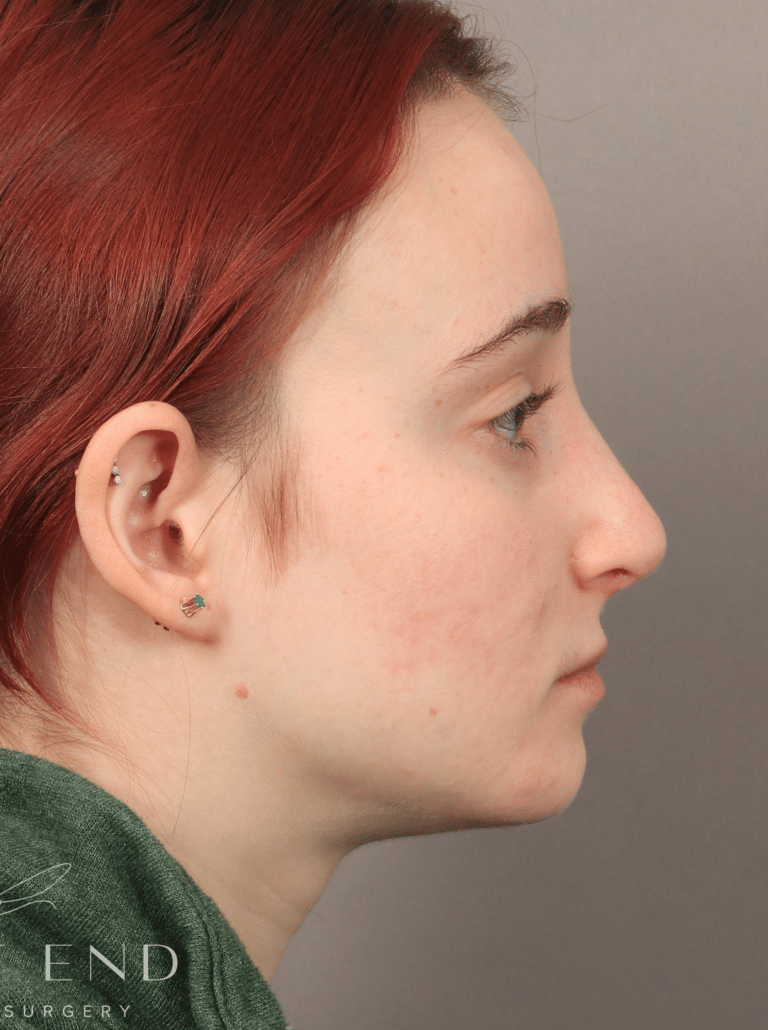 After Image: Open Rhinoplasty (8.5 Months Post-op) - right-side