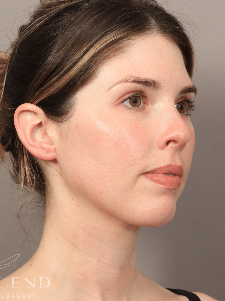 After Image: Liposuction & Renuvion Skin Tightening (10 Days Post-op) - right-front-oblique