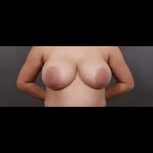 Before Image: Breast Lift with Implant Exchange - front