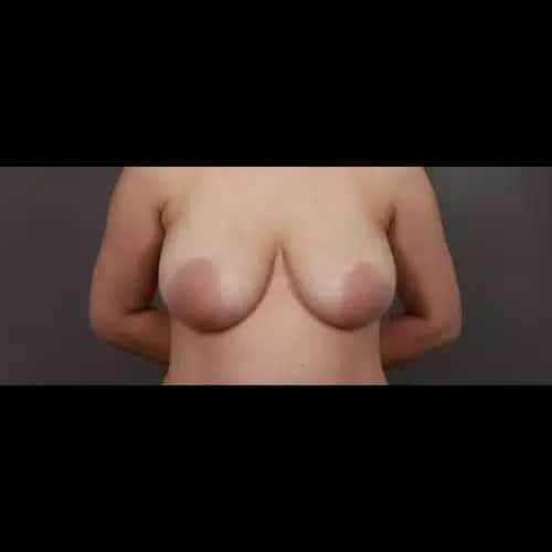 After Image: Breast Lift with Implant Exchange - front