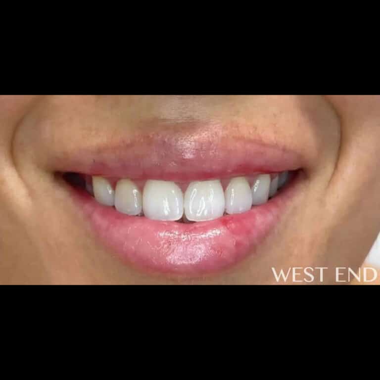 After Image: Lip Filler & Botox for Gummy Smile - front