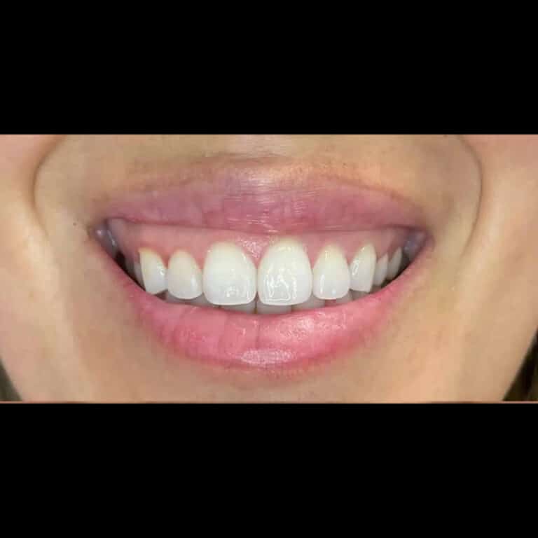 Before Image: Lip Filler & Botox for Gummy Smile - front