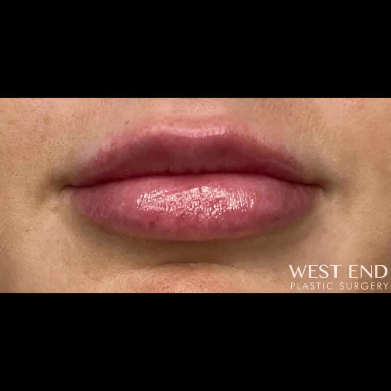 After Image: Lip Filler - front