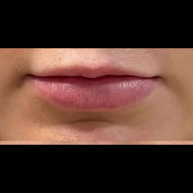 Before Image: Lip Filler - front