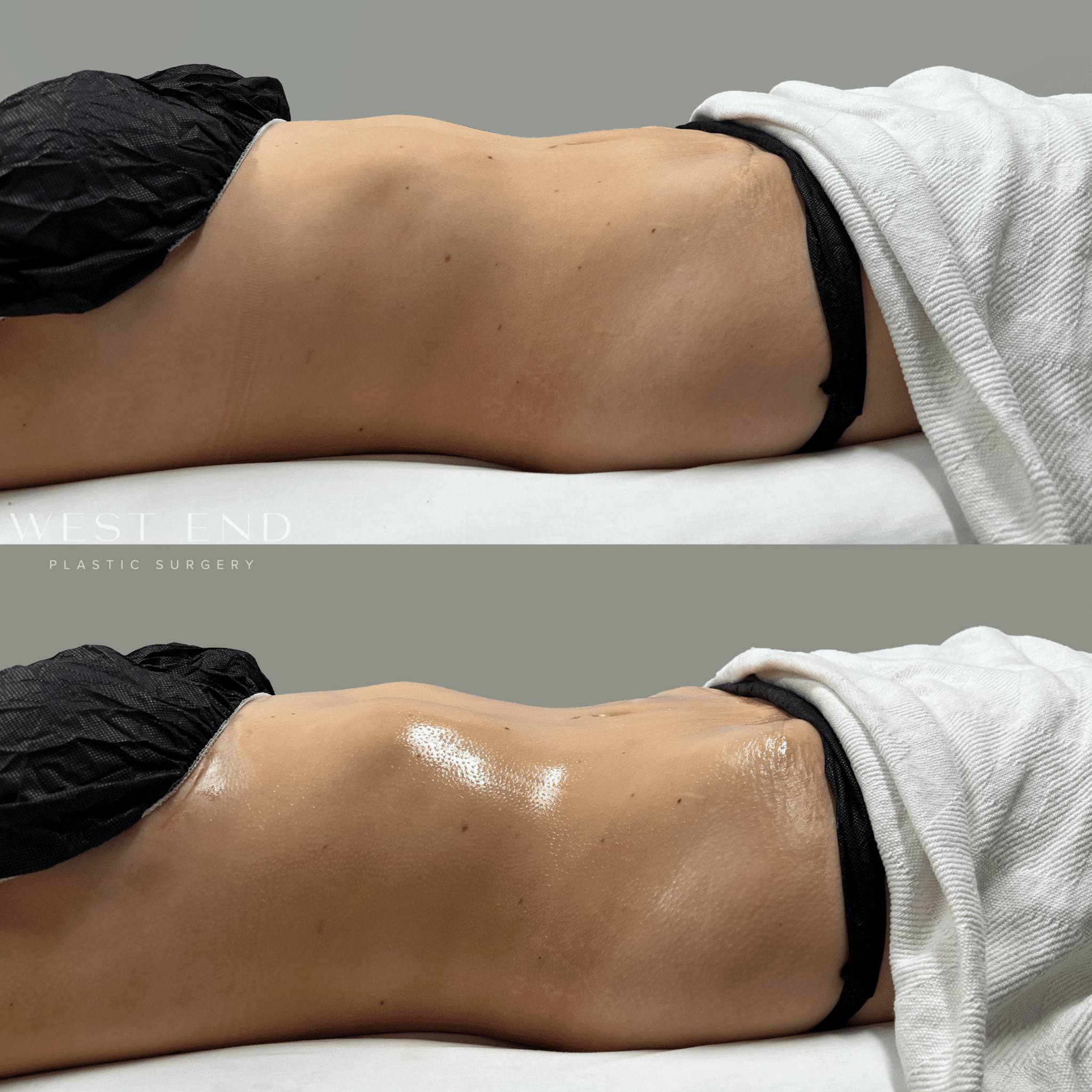 female patient’s torso undergoing lymphatic drainage massage